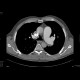 Pulmonary embolism, thrombolysis: CT - Computed tomography
